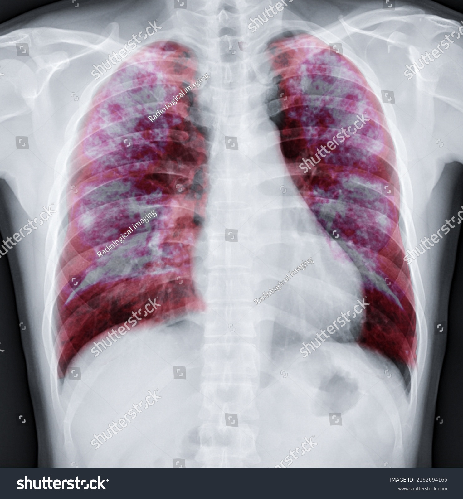 Chest Xray Fusion Lung 3d Rendering Stock Illustration 2162694165 Shutterstock