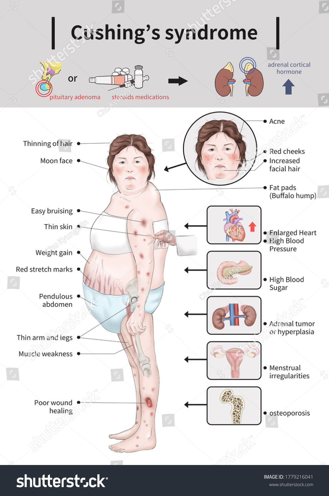 Cushings Syndrome Cause Symptoms Medical Illustration Stock Illustration 1779216041