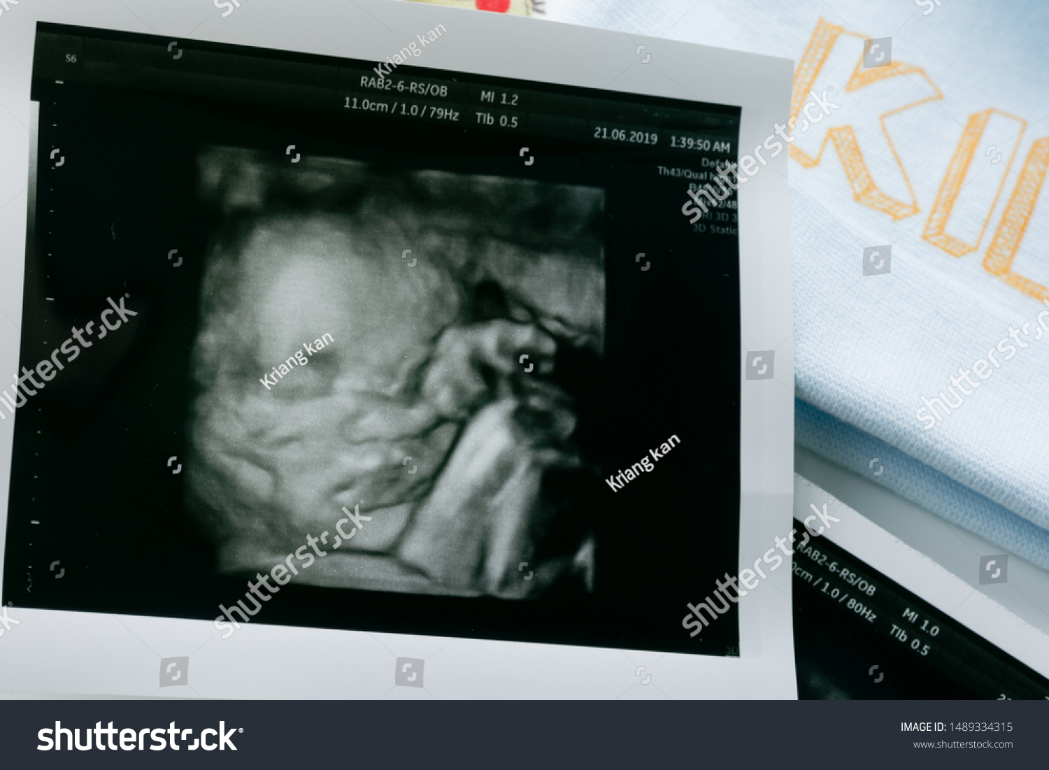 3d4d Ultrasound Film Show Baby Boy 