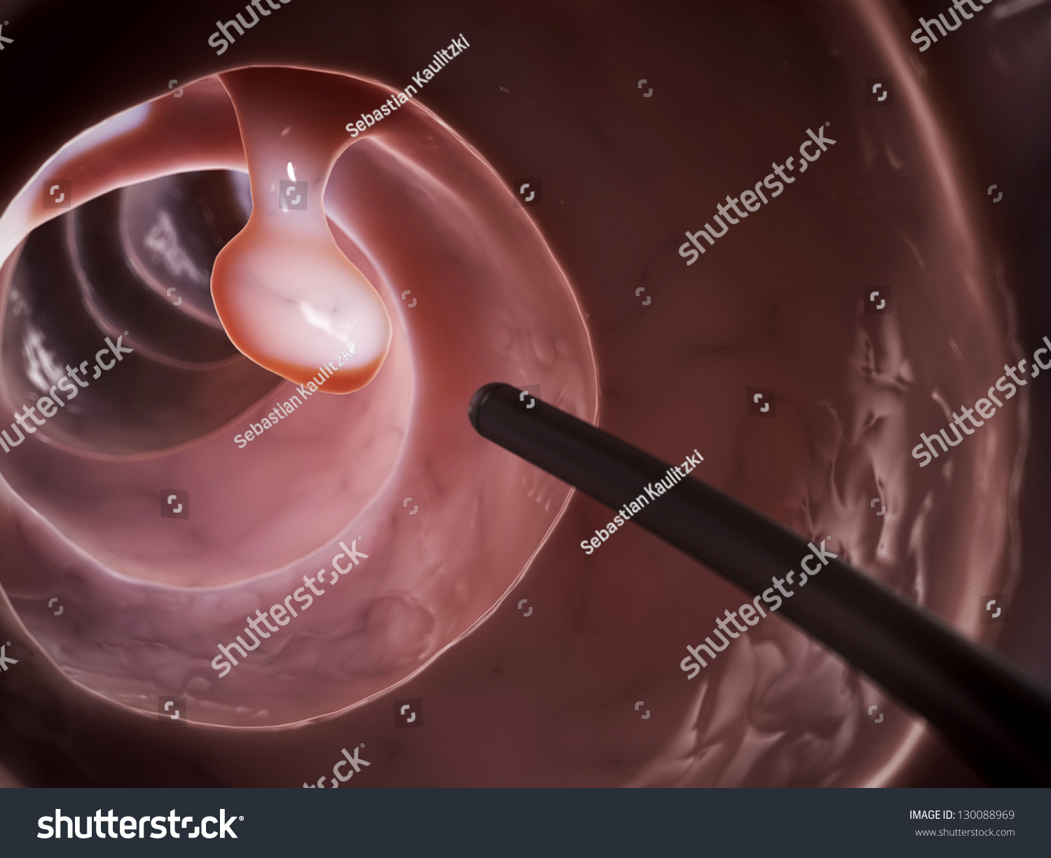 3d Rendered Illustration Colonoscopy Stock Illustration 130088969