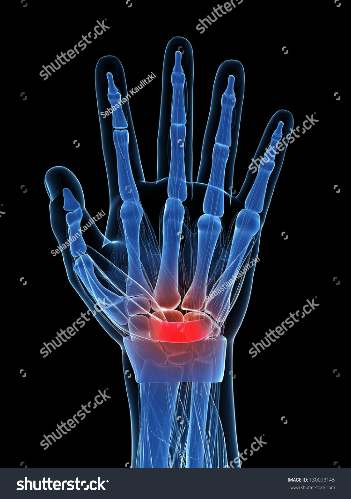 3d Rendered Illustration Carpal Tunnel Syndrome Stock Illustration ...