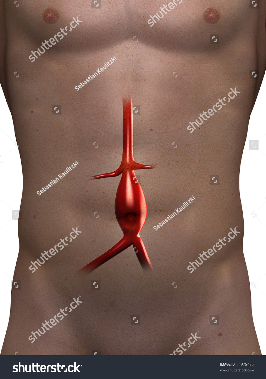 3d Rendered Medical Illustration Aneurysm Aorta Stock Illustration 74978485