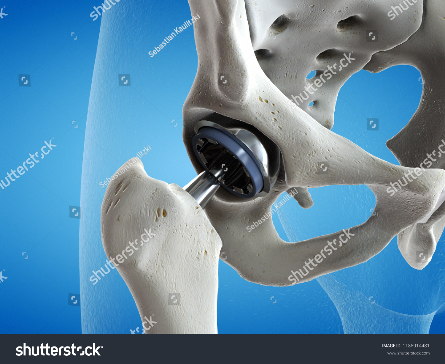 1,941 Replacement joints Stock Illustrations, Images & Vectors ...