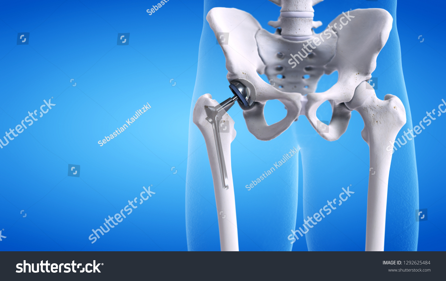 508 Hip prosthesis Stock Illustrations, Images & Vectors | Shutterstock