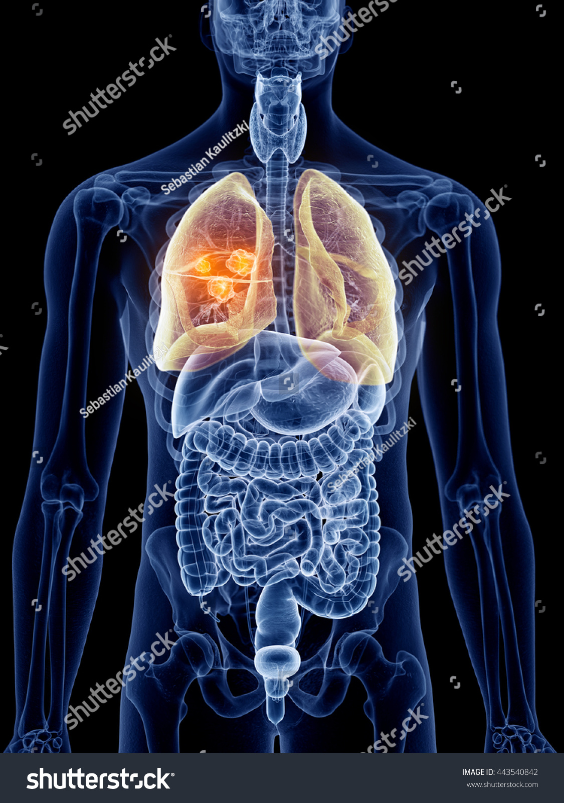3d Rendered, Medically Accurate Illustration Of Lung Cancer - 443540842 ...