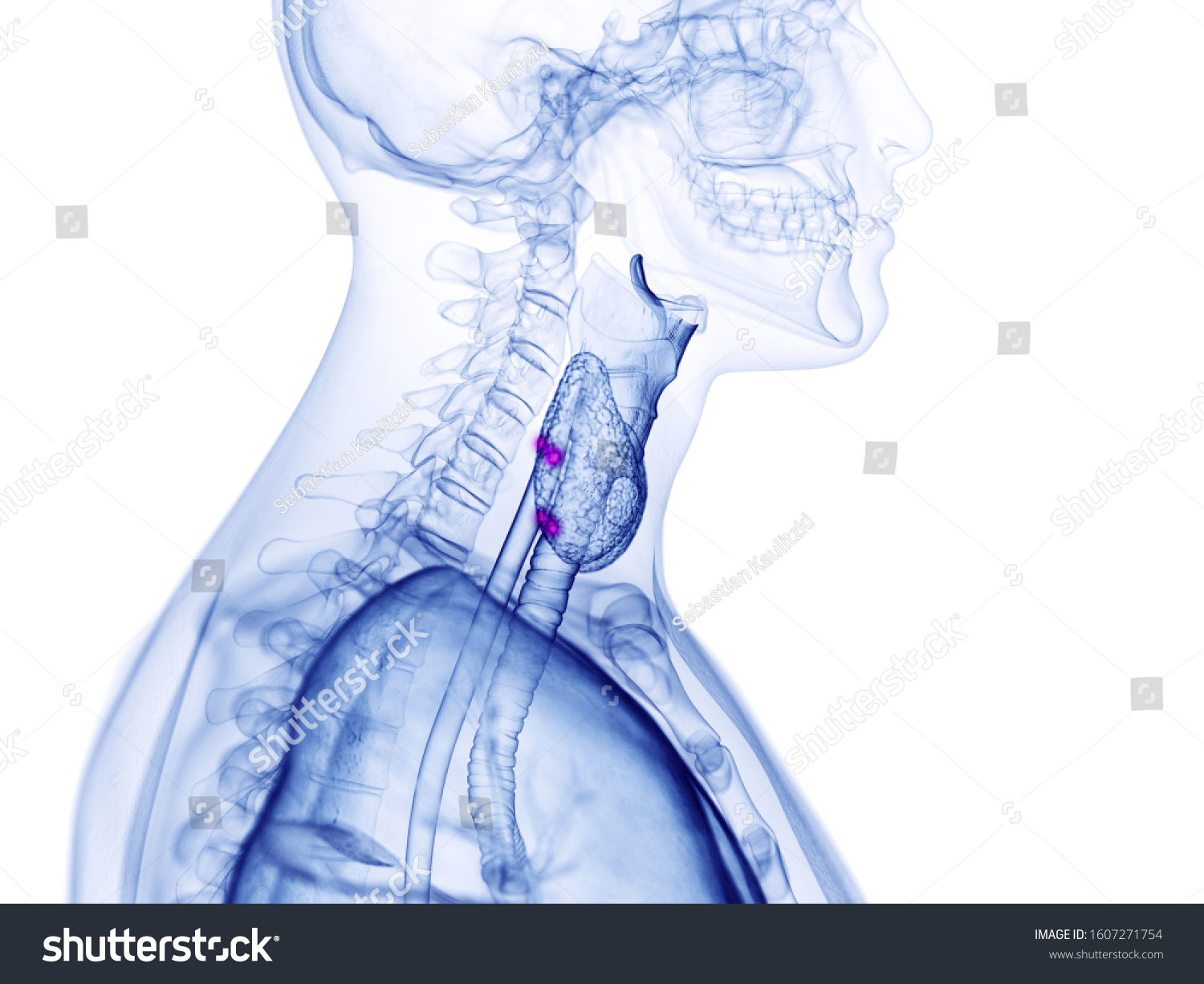 13 Para Thyroiditis Images Stock Photos And Vectors Shutterstock