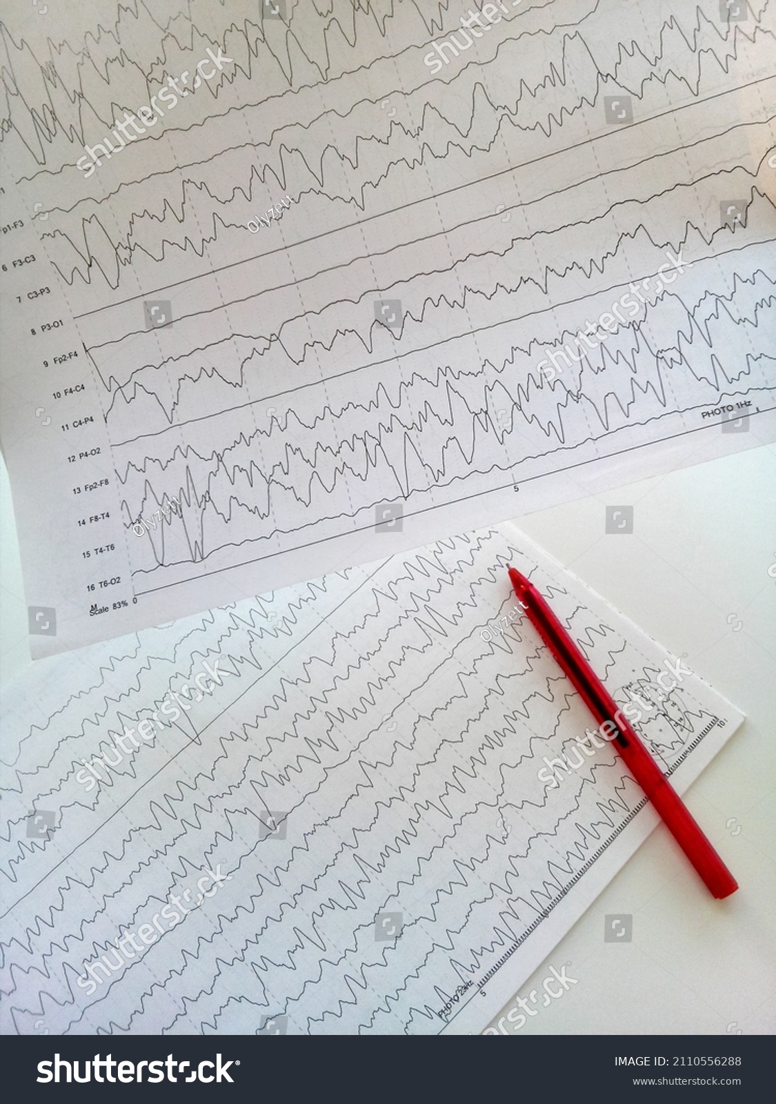 Electroencephalogram Eeg Patient Confirming Epilepsy Stock Photo ...