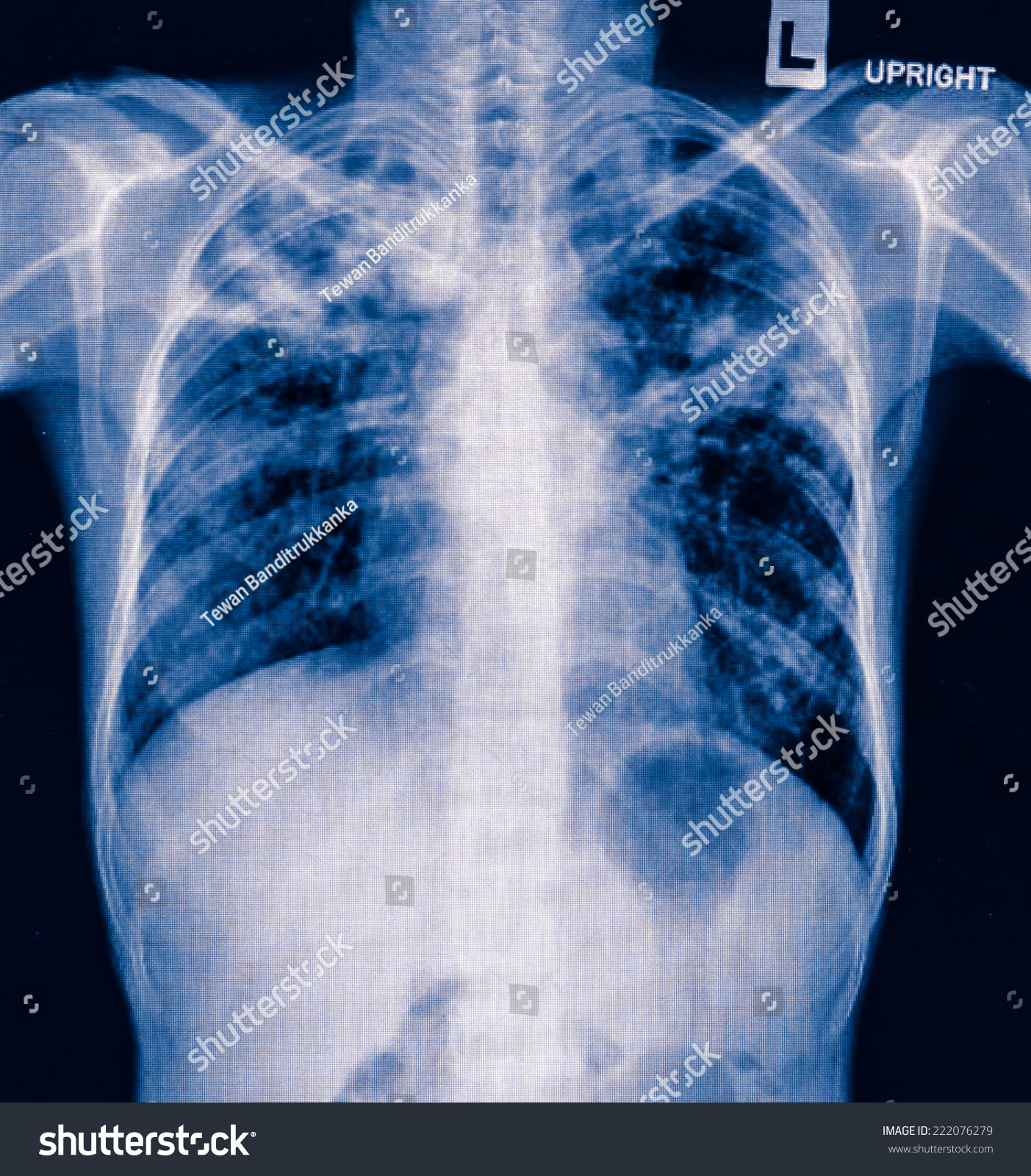 Film Chest Of A Patient Bilateral Pneumonia Stock Photo 222076279 ...