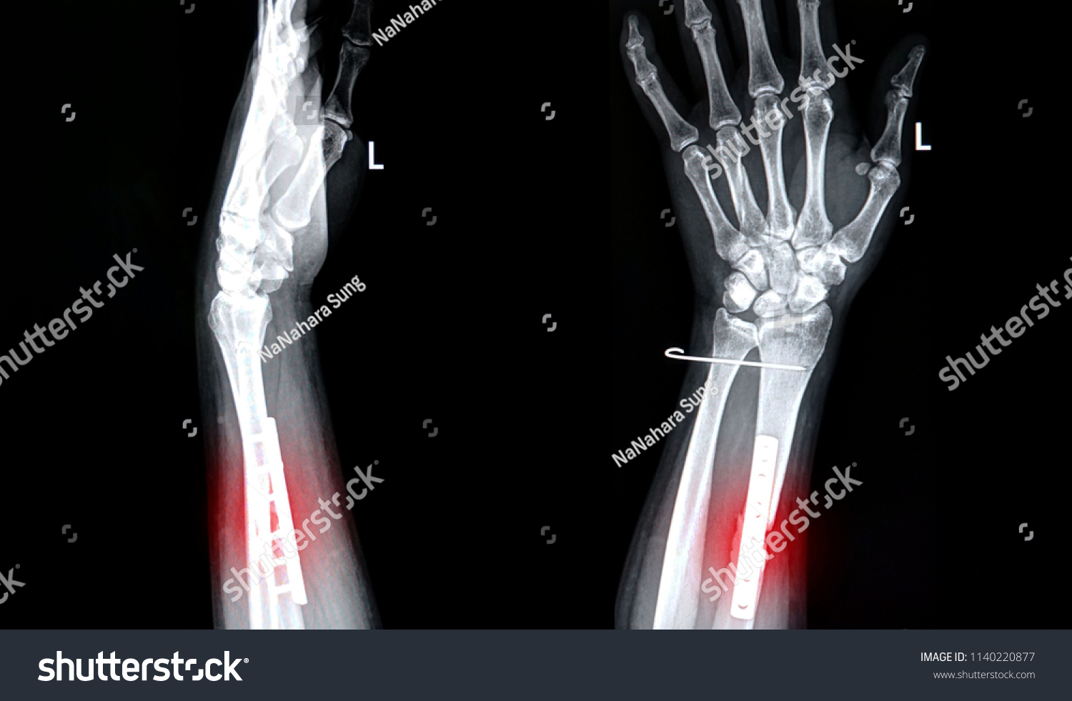 Film Xray Image Left Wrist Forearm Stock Photo 1140220877 