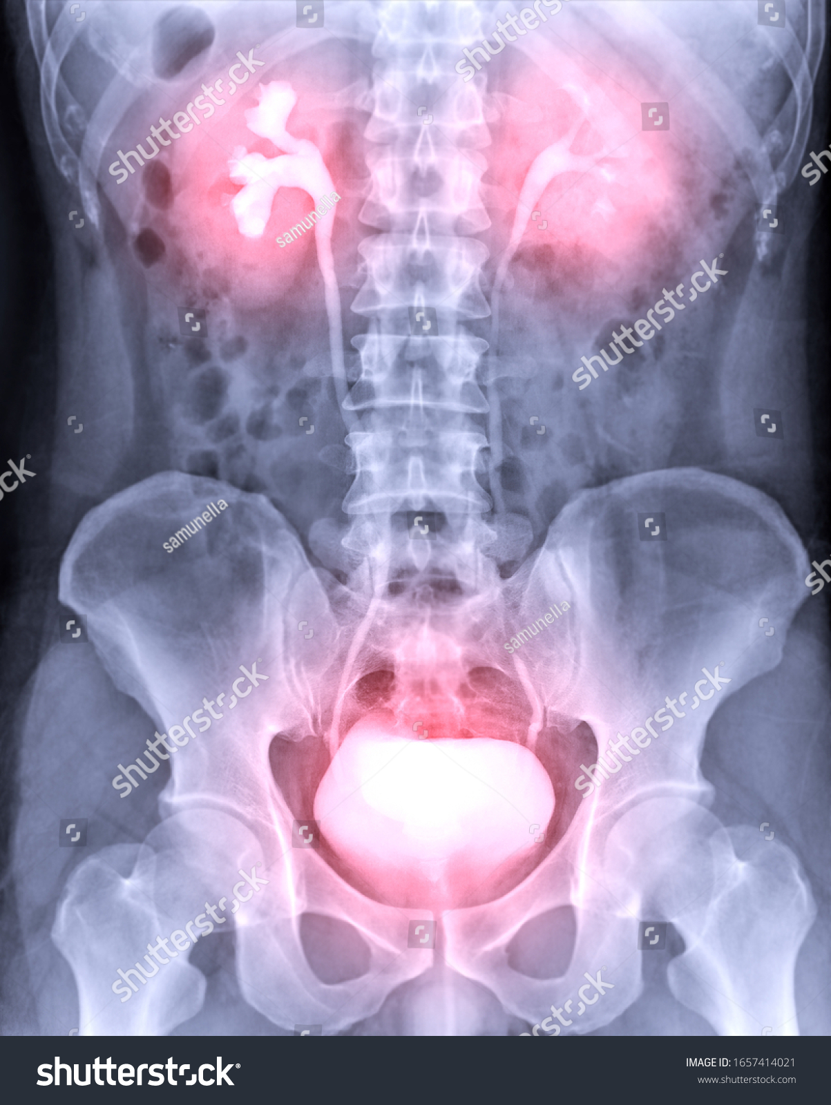 Intravenous Pyelogram Ivp Xray Exam Urinary Stock Photo (Edit Now ...