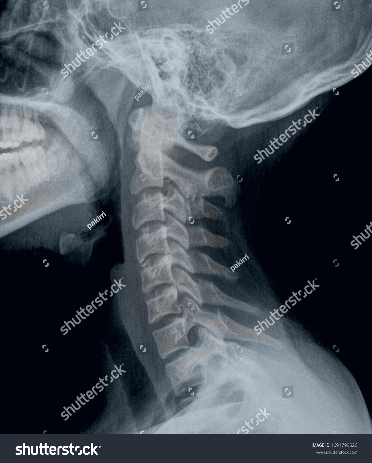 Lateral X Ray Head Neck Bones Stock Photo 1691799526 | Shutterstock