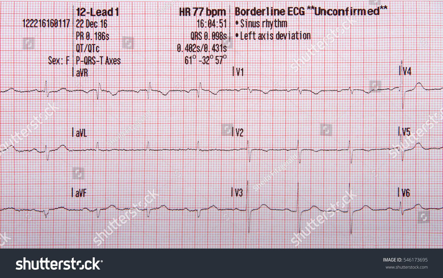 Borderline Ecg