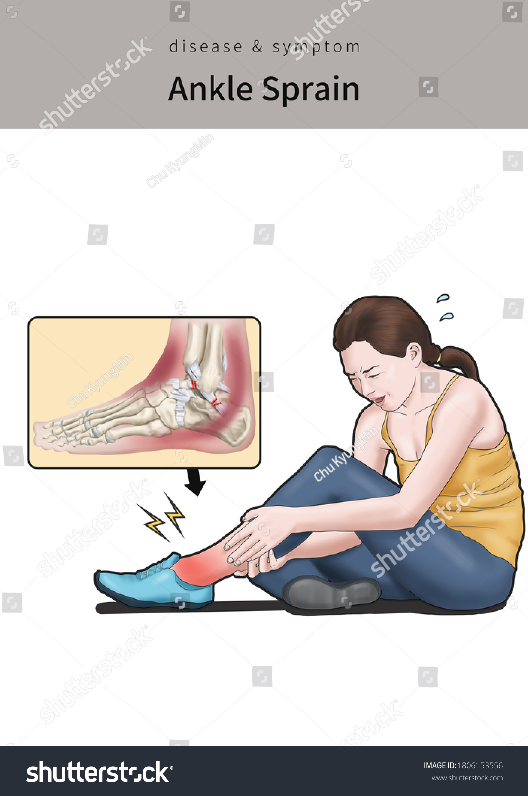 Medical Illustration Explain Ankle Sprain Stock Illustration 1806153556 ...