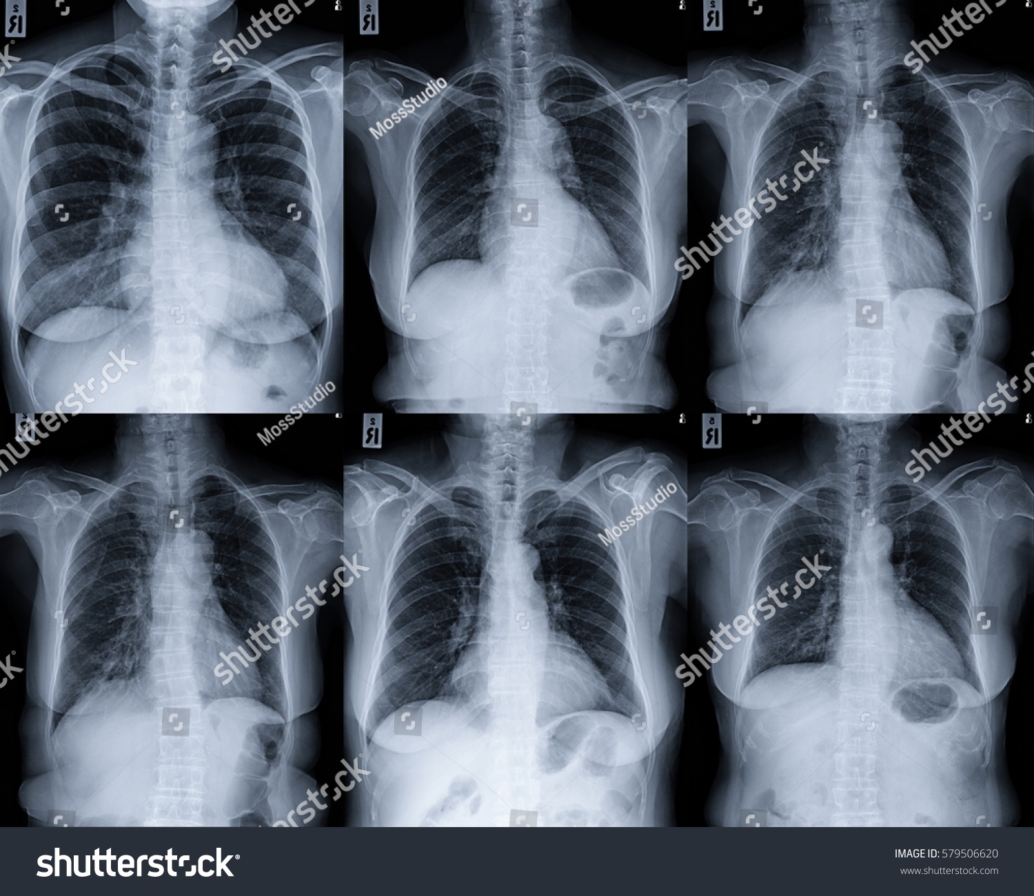 Mild Cardiomegaly Seen Chest Radiography Collection Stock Photo Edit Now 579506620