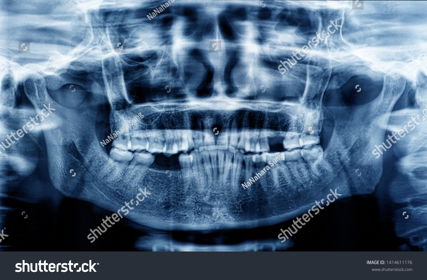 Panoramic Radiography Human Teeth Bones Stock Photo 1414611176 ...