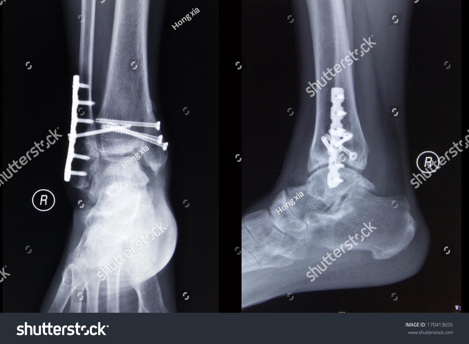 Right Ankle Fracture After Operation Stock Photo 170413655 : Shutterstock