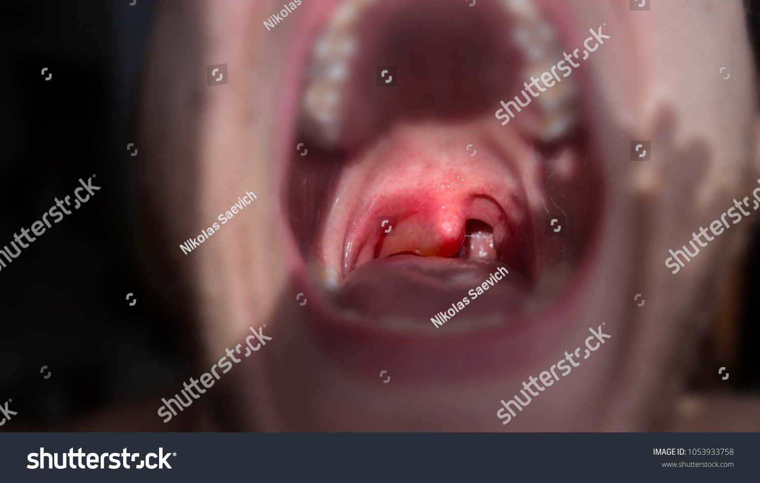 Sore Throat Allergic Reaction Angioedema Stock Photo Edit Now 1053933758