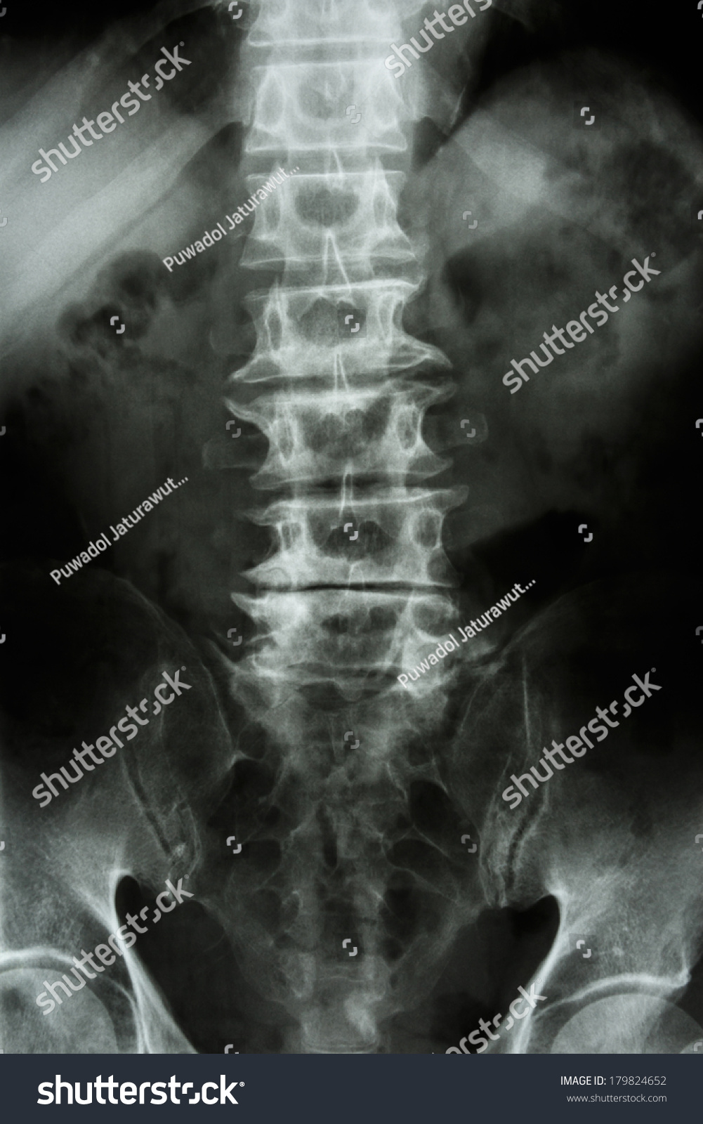 Spondylosis Film Xray Ls Spine Lumbarsacrum Stock Photo (Edit Now ...