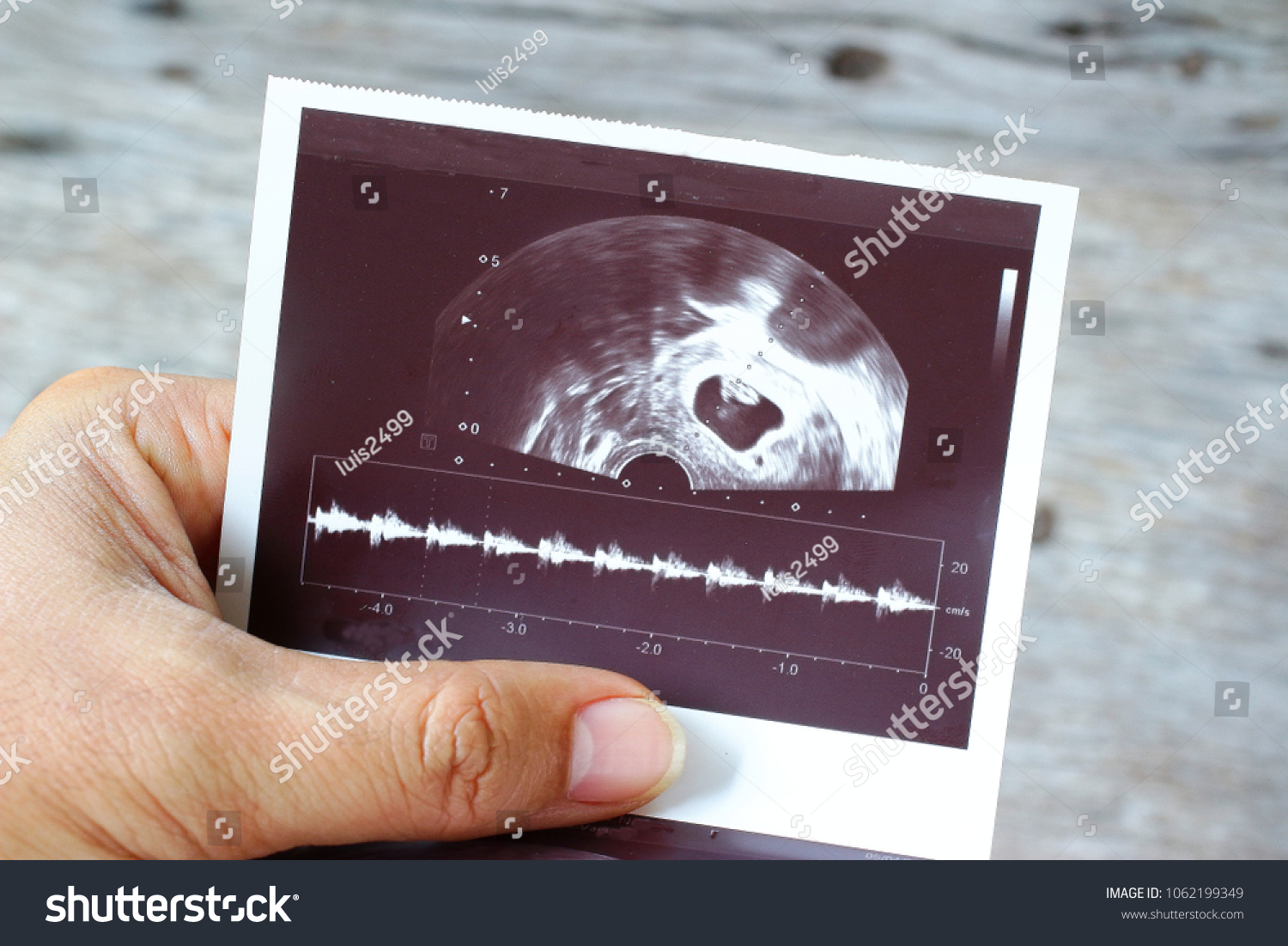 5 Weeks Pregnant Ultrasound Film Baby Stock Photo Edit Now