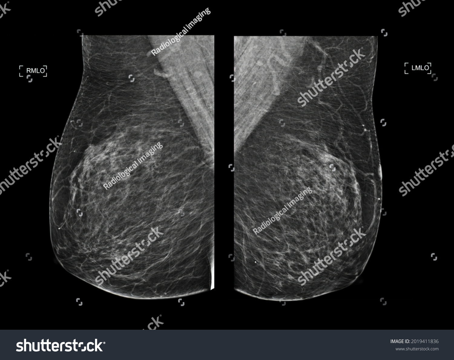 Xray Digital Mammogram Mammography Both Side Stock Illustration Shutterstock