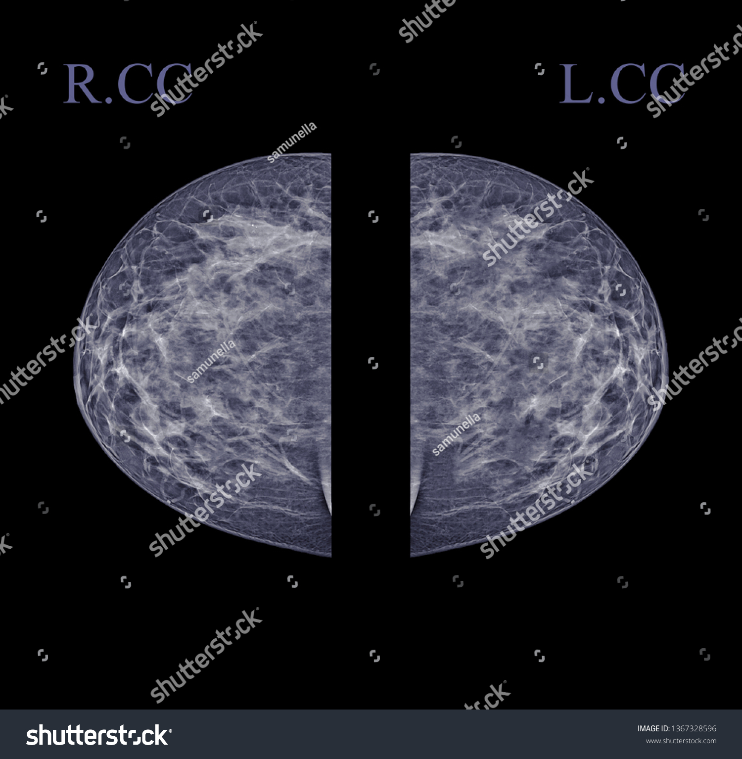 Xray Digital Mammogram Mammography Both Side Stock Illustration Shutterstock