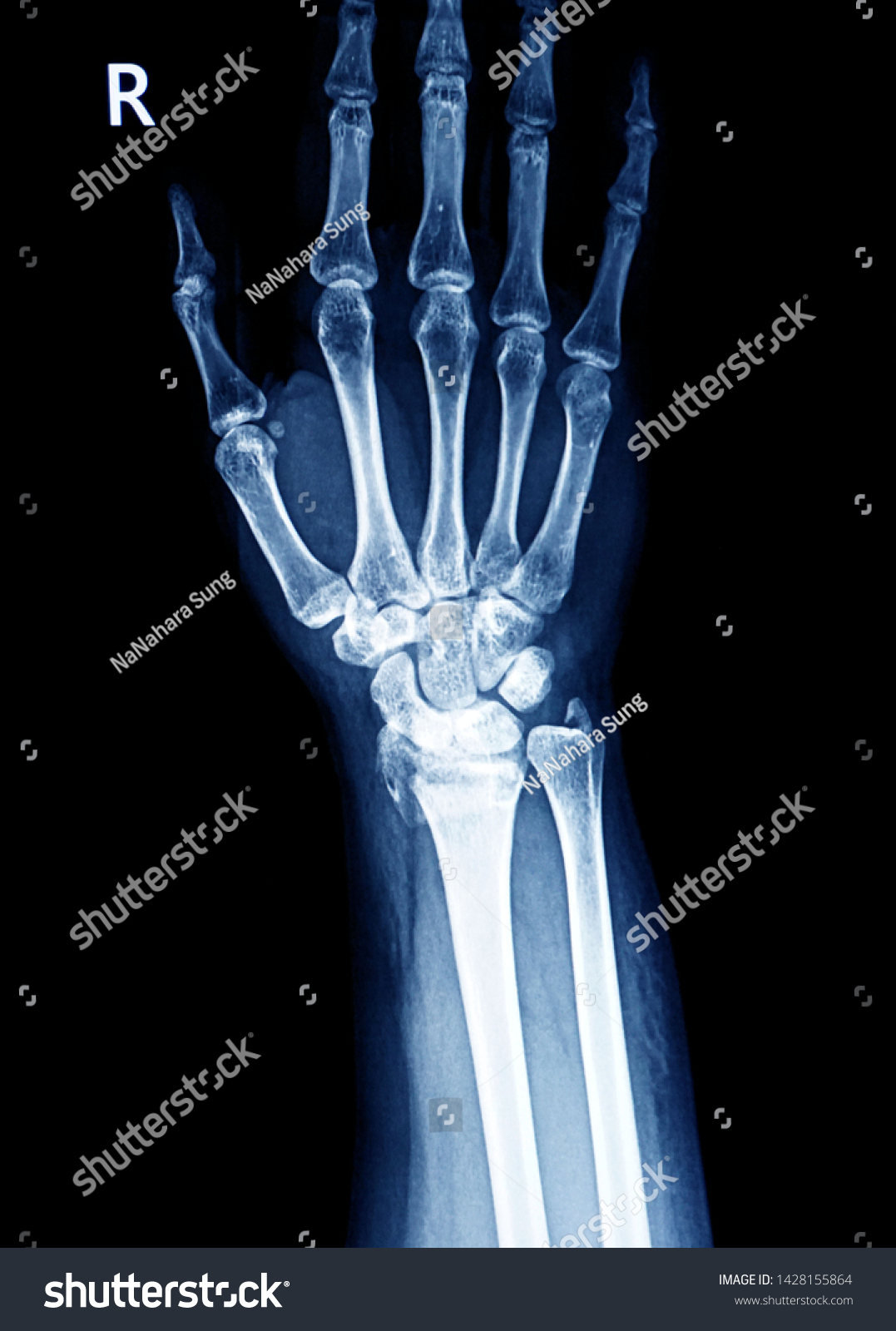 Xray Image Wrist Joint Show Fracture Stock Photo 1428155864 | Shutterstock