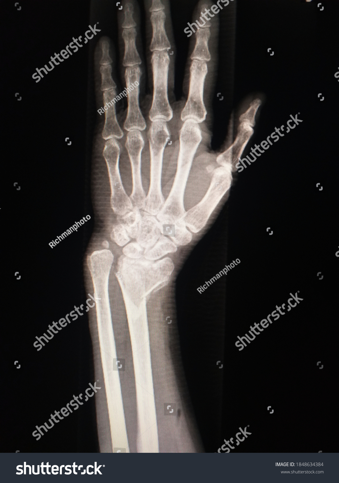 Xray Wrist Apfracture Displacement Distal End Stock Photo 1848634384 ...