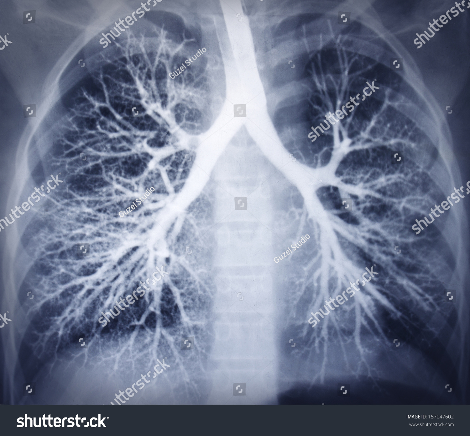 支气管镜检查图像。胸部x光片。健康的肺-医疗