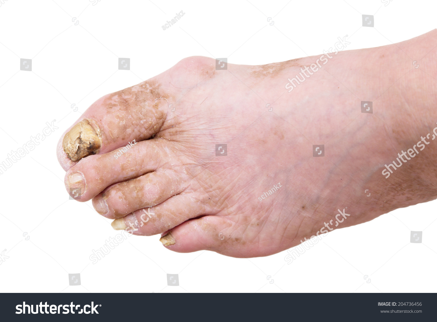 指甲真菌感染的人的脚-医疗保健,人物-海洛创意