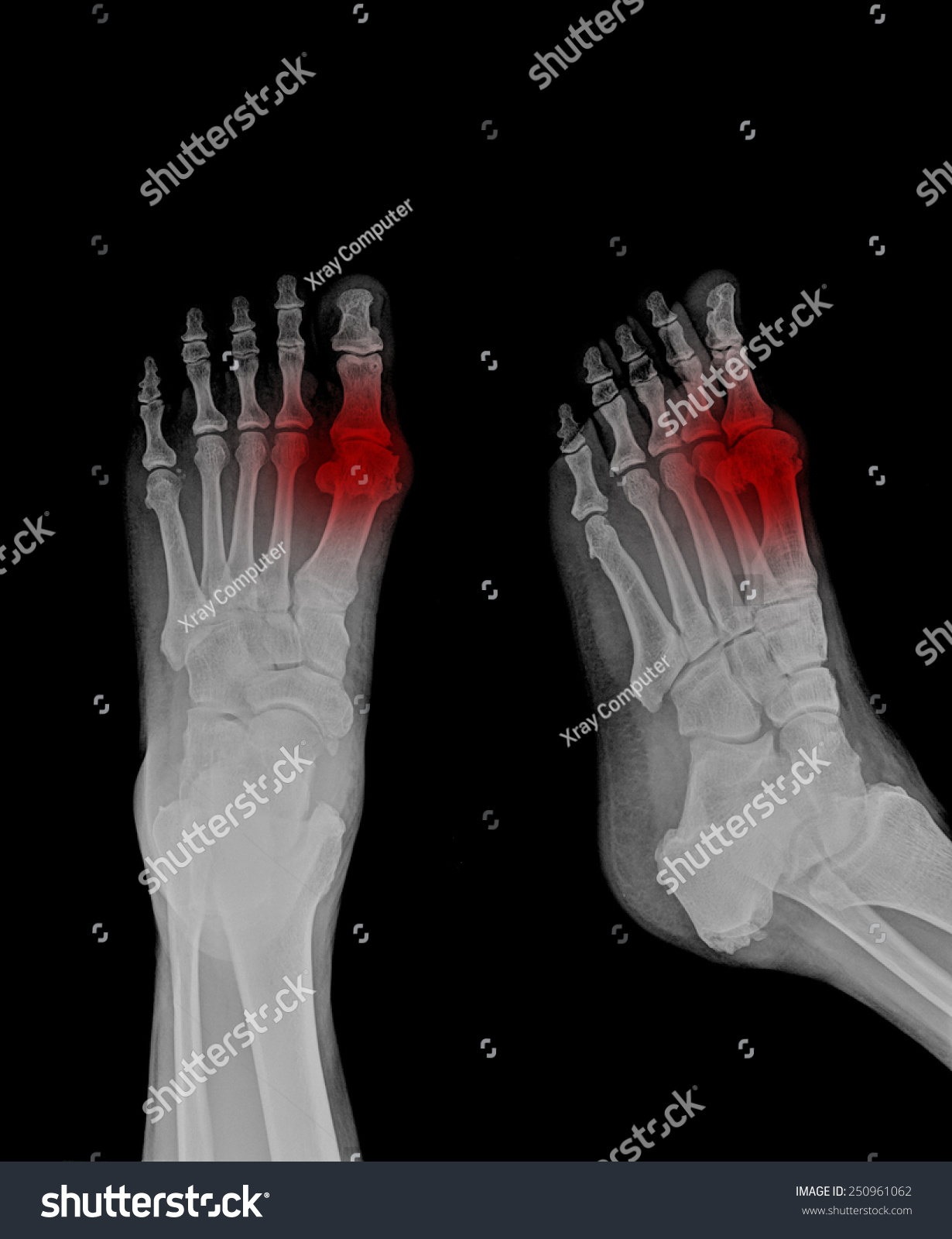 病人的x光显示大脚趾疼痛-医疗保健,人物-海洛