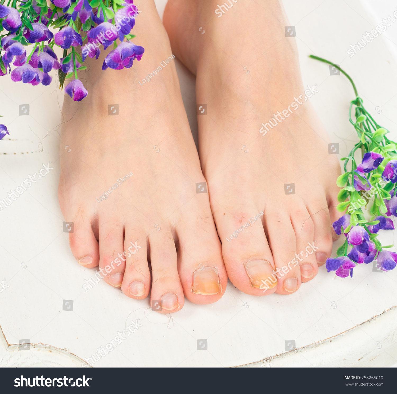 靠近人类的脚开裂和剥落的大脚趾脚趾指甲。脚