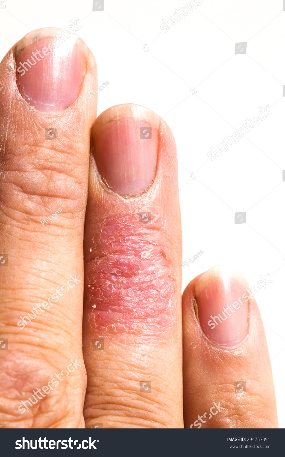 湿疹皮炎过敏性皮疹特写地区成人手指。孤立在