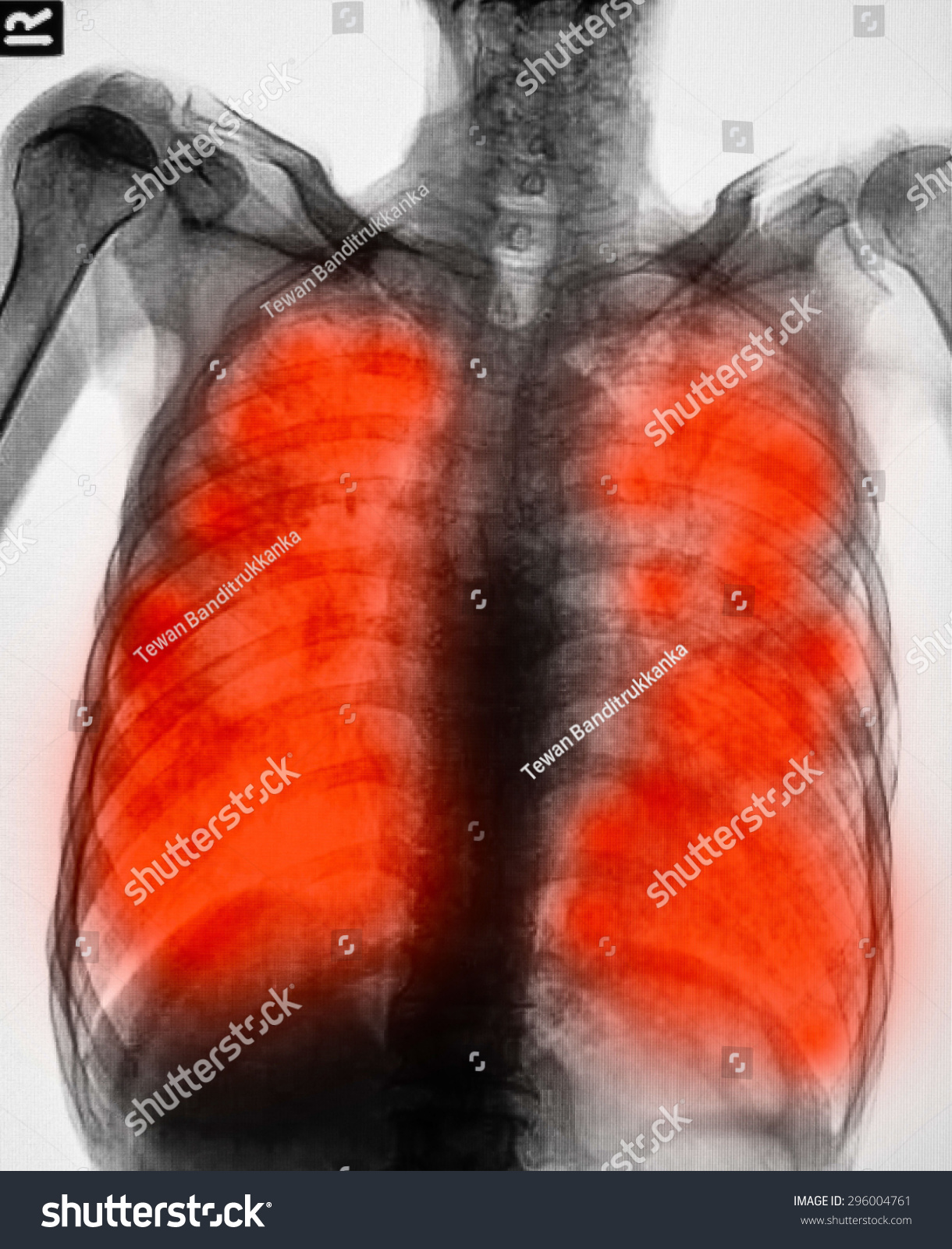 电影胸部x光片显示腔对肺纤维化和间质和片状