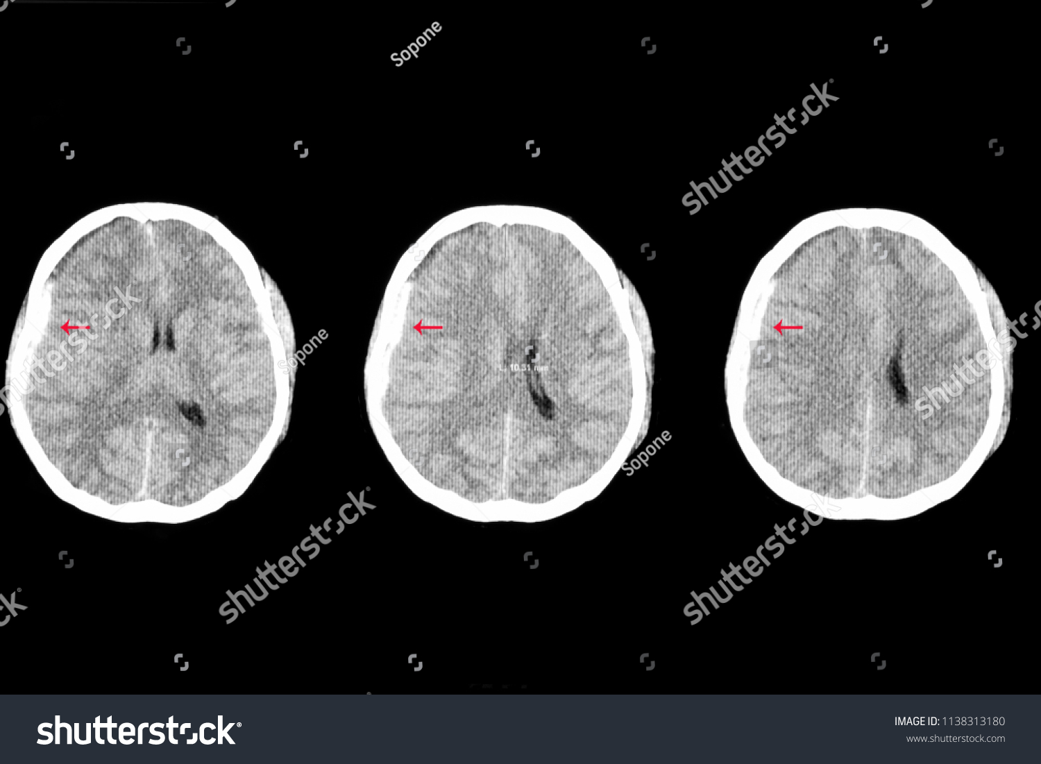 右硬膜下出血と脳の左方への移動による浮腫を示す外傷性外傷を持つ患者の軸方向脳ctスキャン 車の事故で脳内出血や血栓ができた の写真素材 今すぐ編集