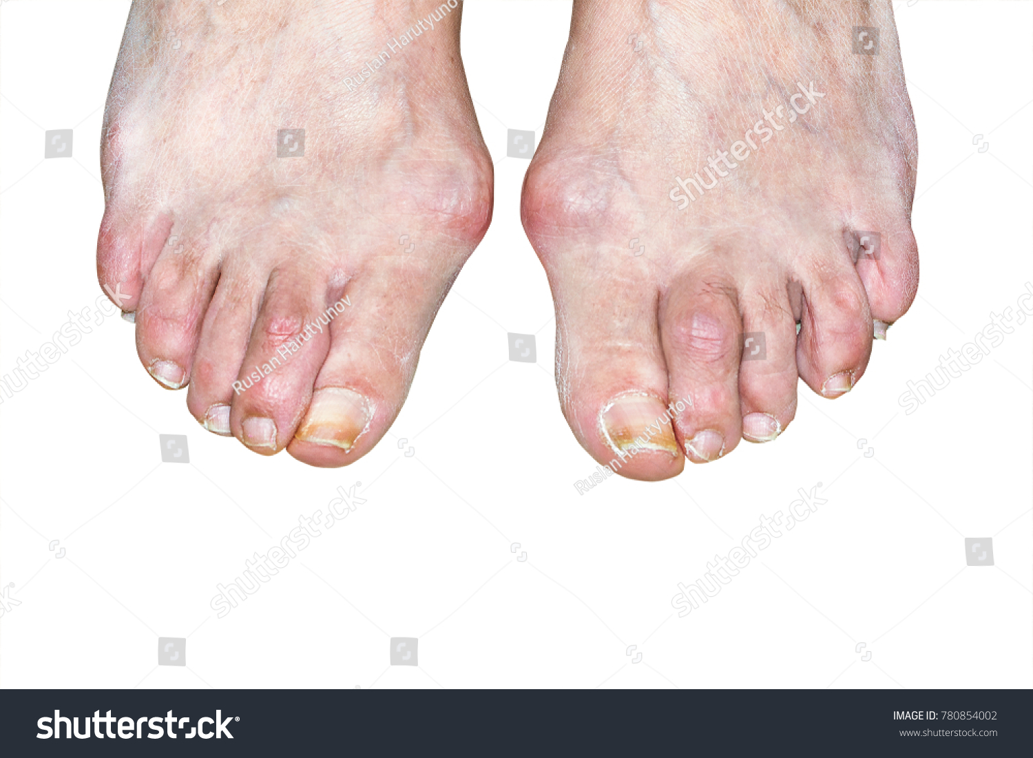 Bunion Deformity Joint Connecting Big Toe Stock Photo (Edit Now) 780854002