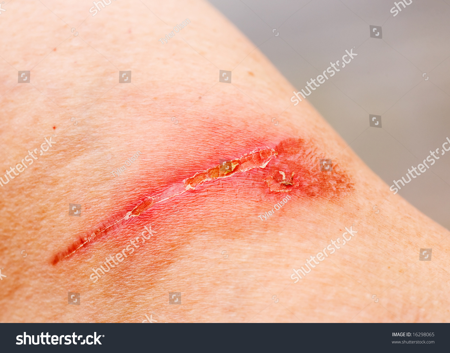 A Burn Scar That Is Partly Healed Stock Photo 16298065 : Shutterstock