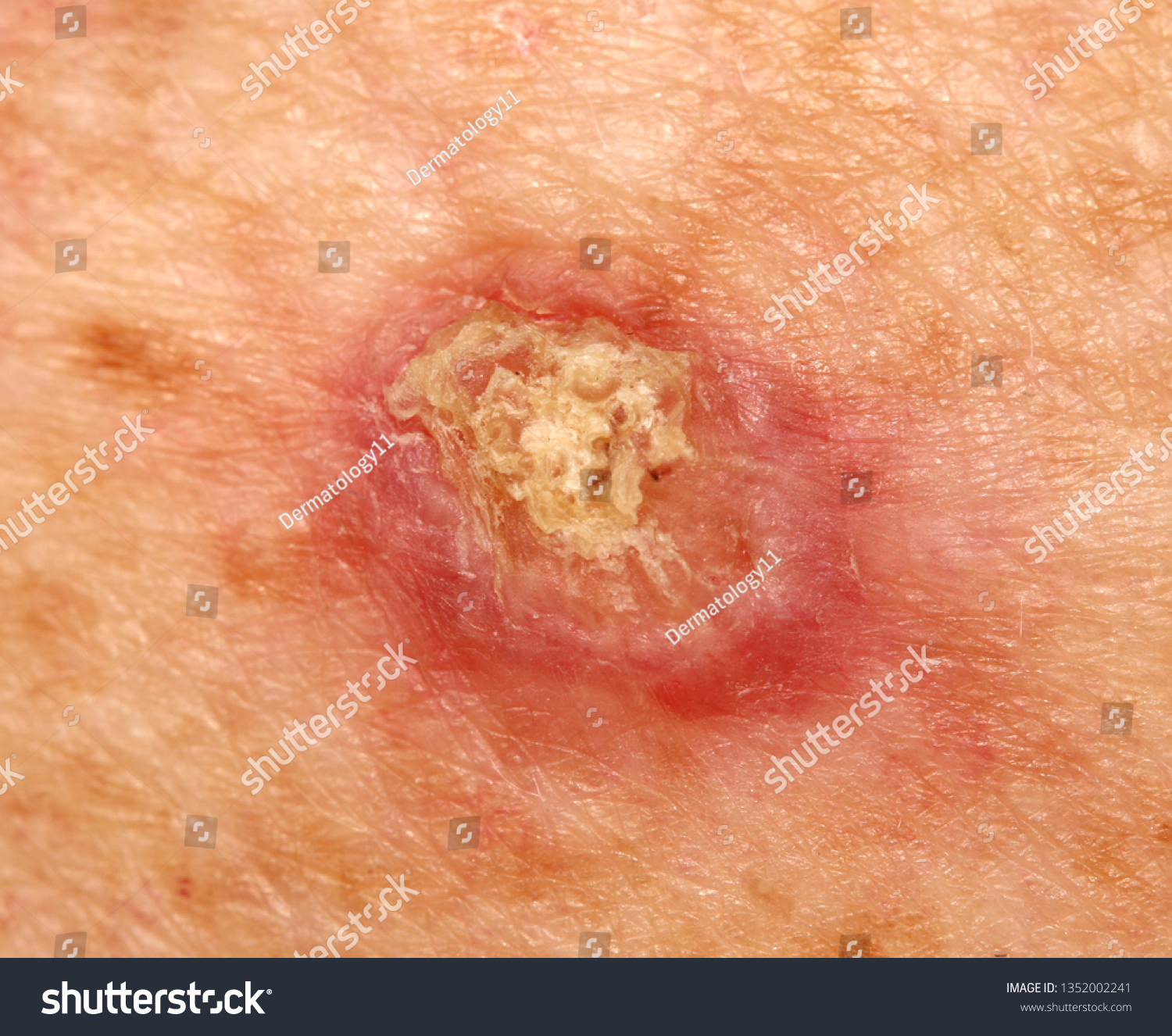 Case Invasive Squamous Cell Carcinoma Stock Photo Edit Now 1352002241