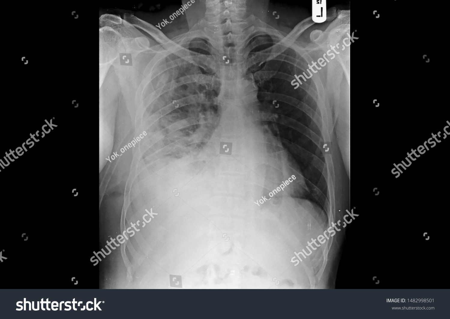 Chest Xray Patient Presented Dyspnea Showing Stock Photo (Edit Now ...