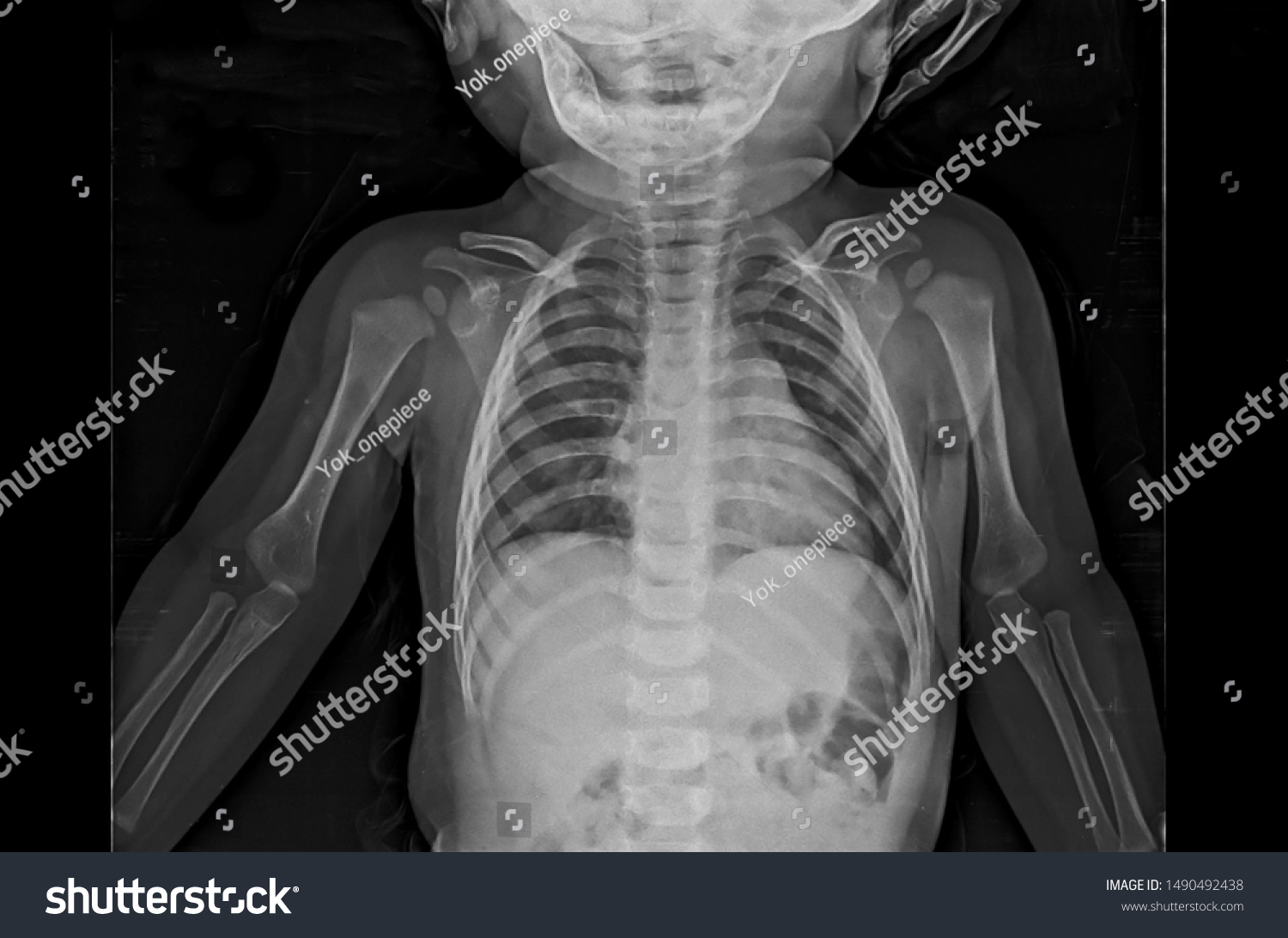 Chest Xray Infant Patient Showing Normal Foto de stock 1490492438