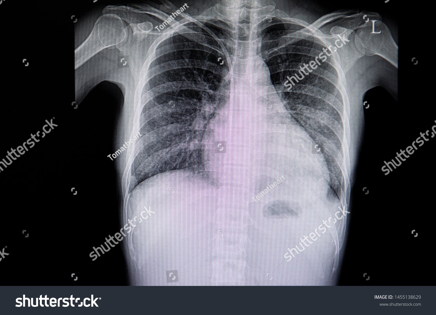 Chest Xray Film Patient Double Lumen Stock Photo (Edit Now) 1455138629