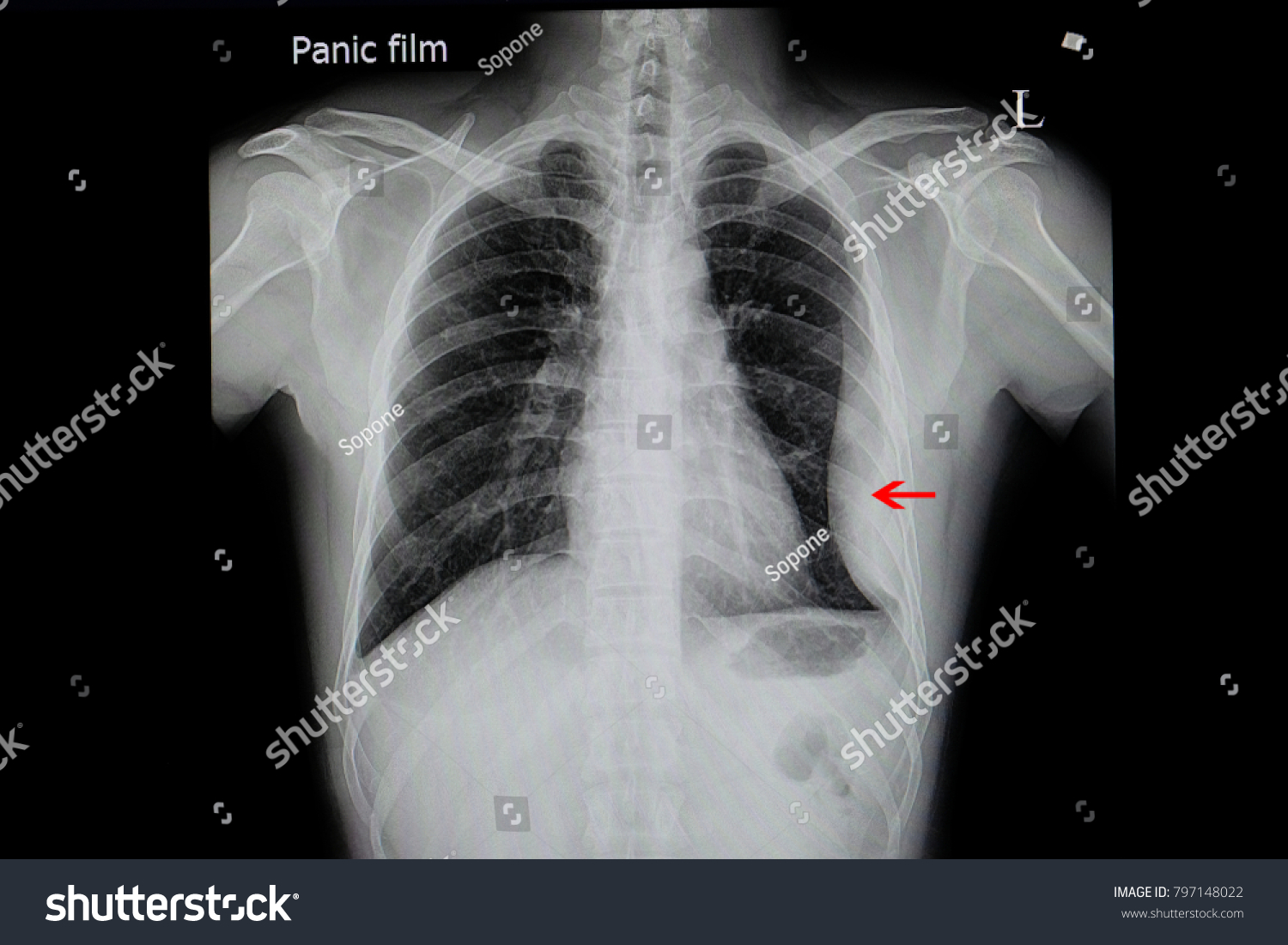 Chest Xray Film Patient Loculated Pleural Stock Photo Edit Now 797148022