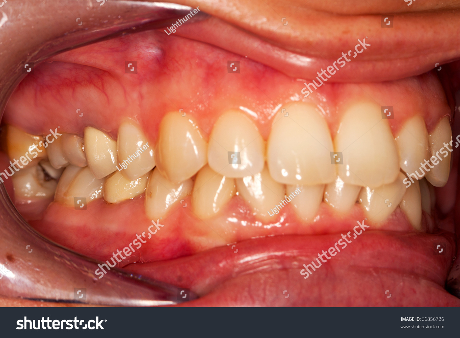 A Closed Mouth Photographed With The Aid Of A Retractor - Vestibular ...