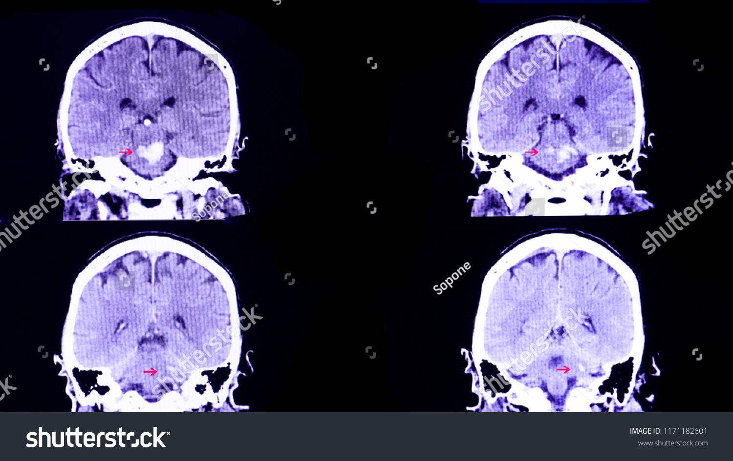 Ct Scan Brain Patient Intracranial Hemorrhage Stock Photo 1171182601 ...