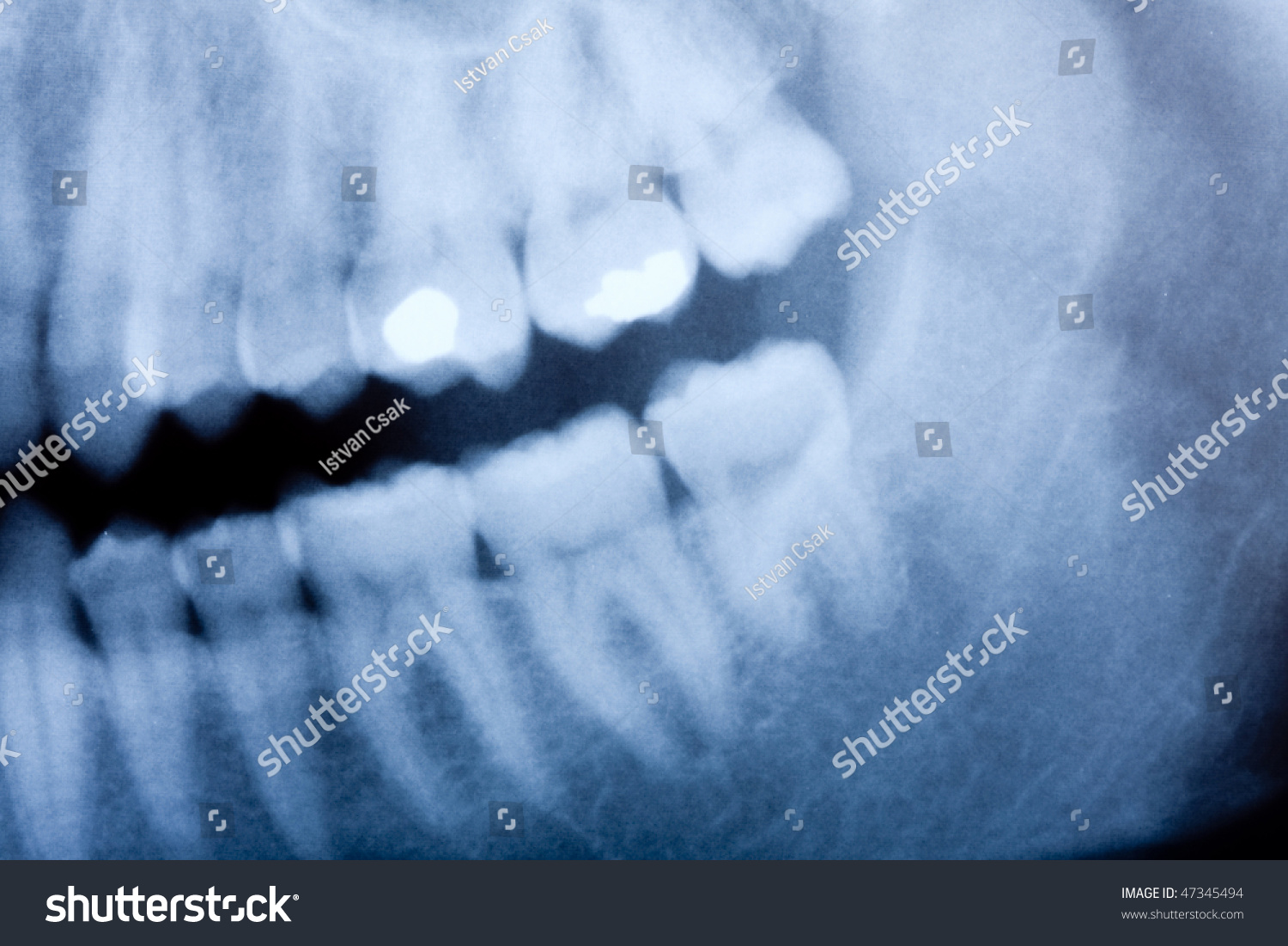 Dental Xray Detail Stock Photo 47345494 | Shutterstock