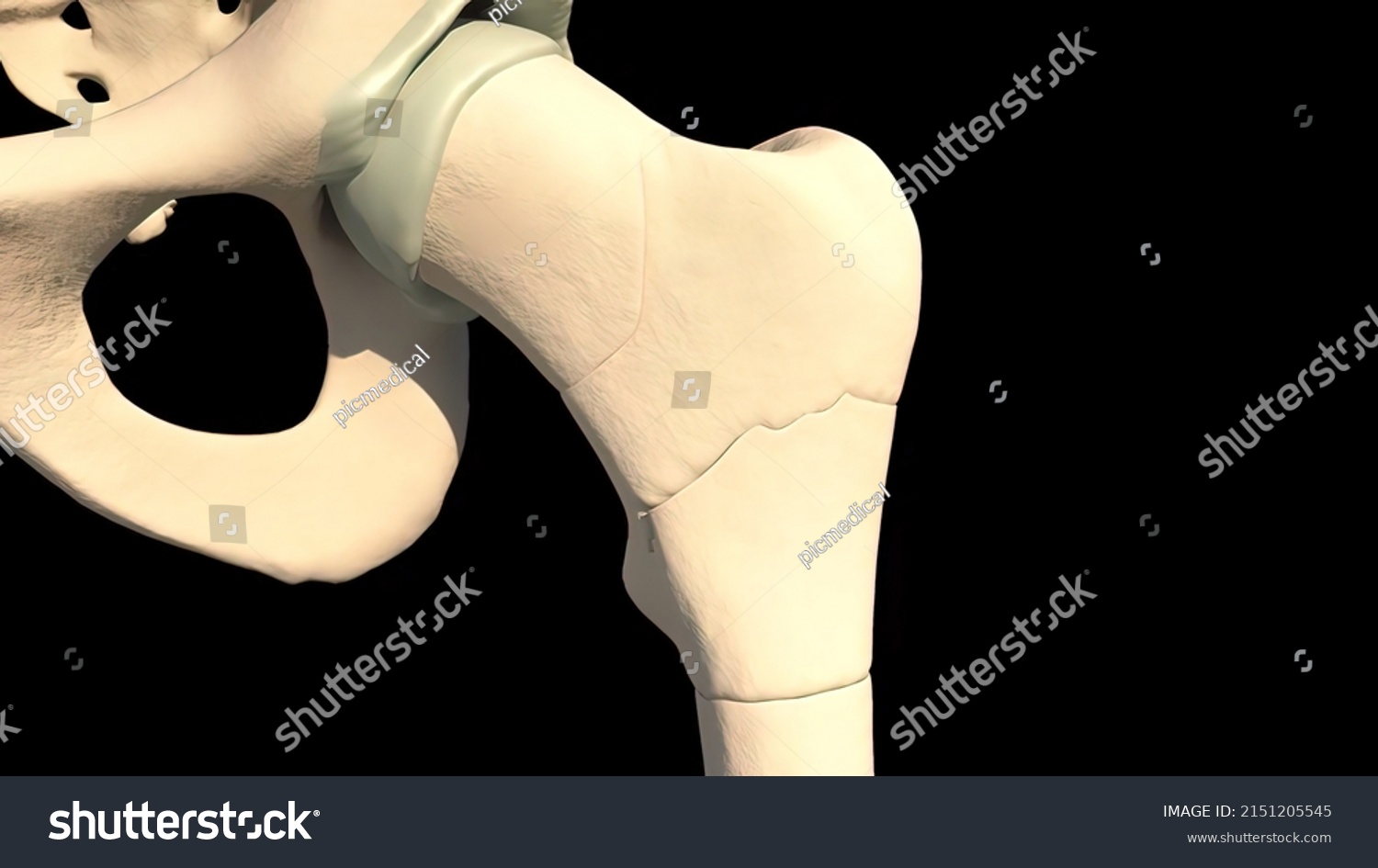 Femur Fracture Break Crack Crush Injury Stock Illustration 2151205545 ...