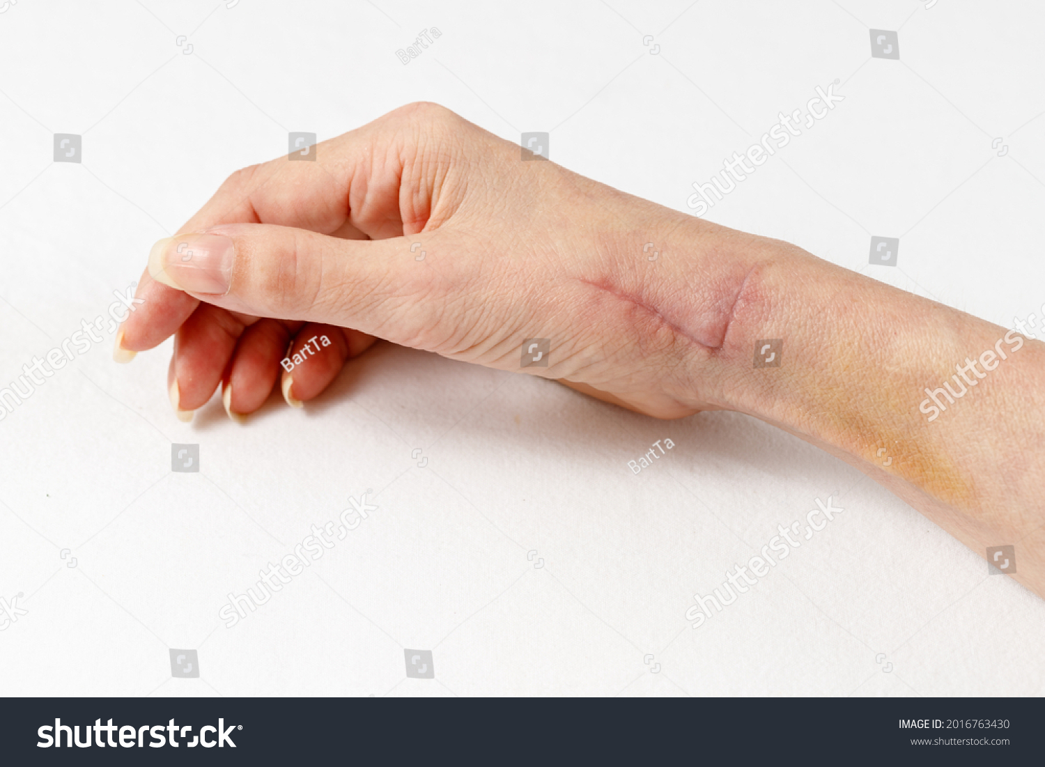 11 Radial scar Images, Stock Photos & Vectors | Shutterstock