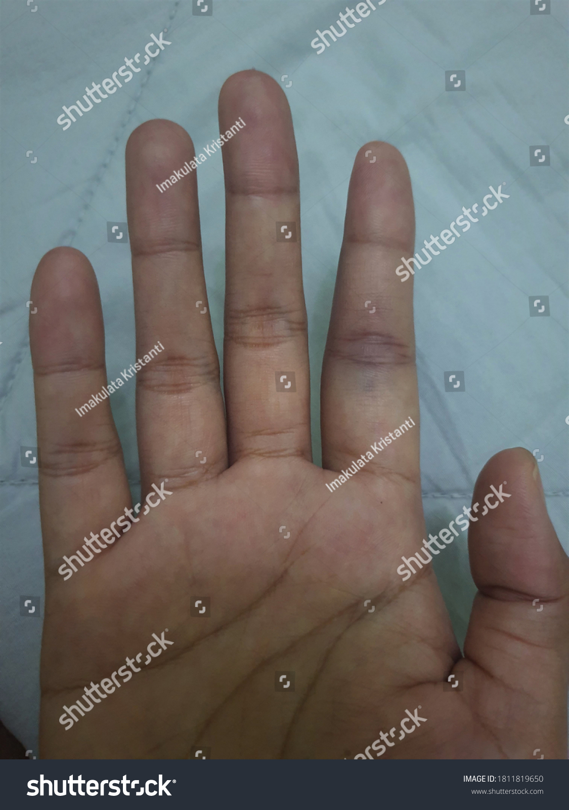 jammed-finger-common-injury-that-can-stock-photo-1811819650-shutterstock