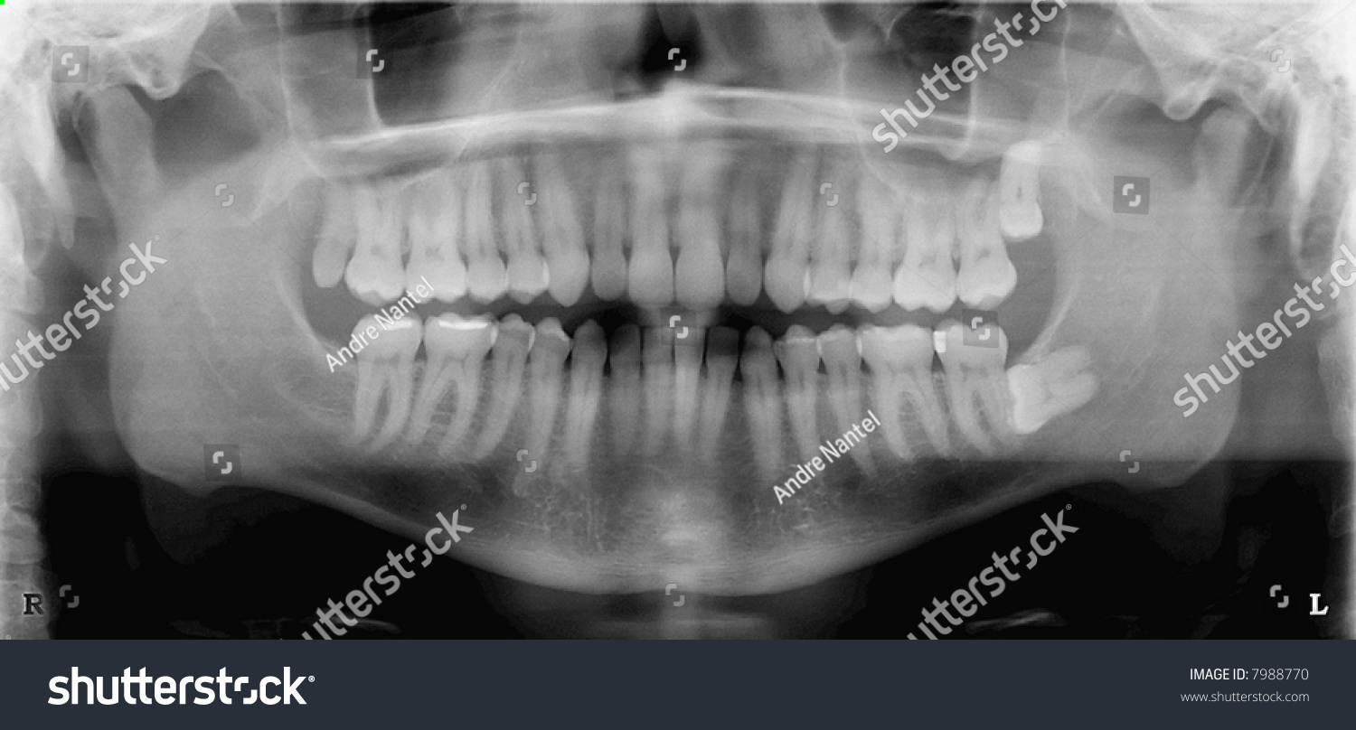 A Panoramic Dental X-Ray Of A 41 Year Old Male. Fillings And Wisdom ...