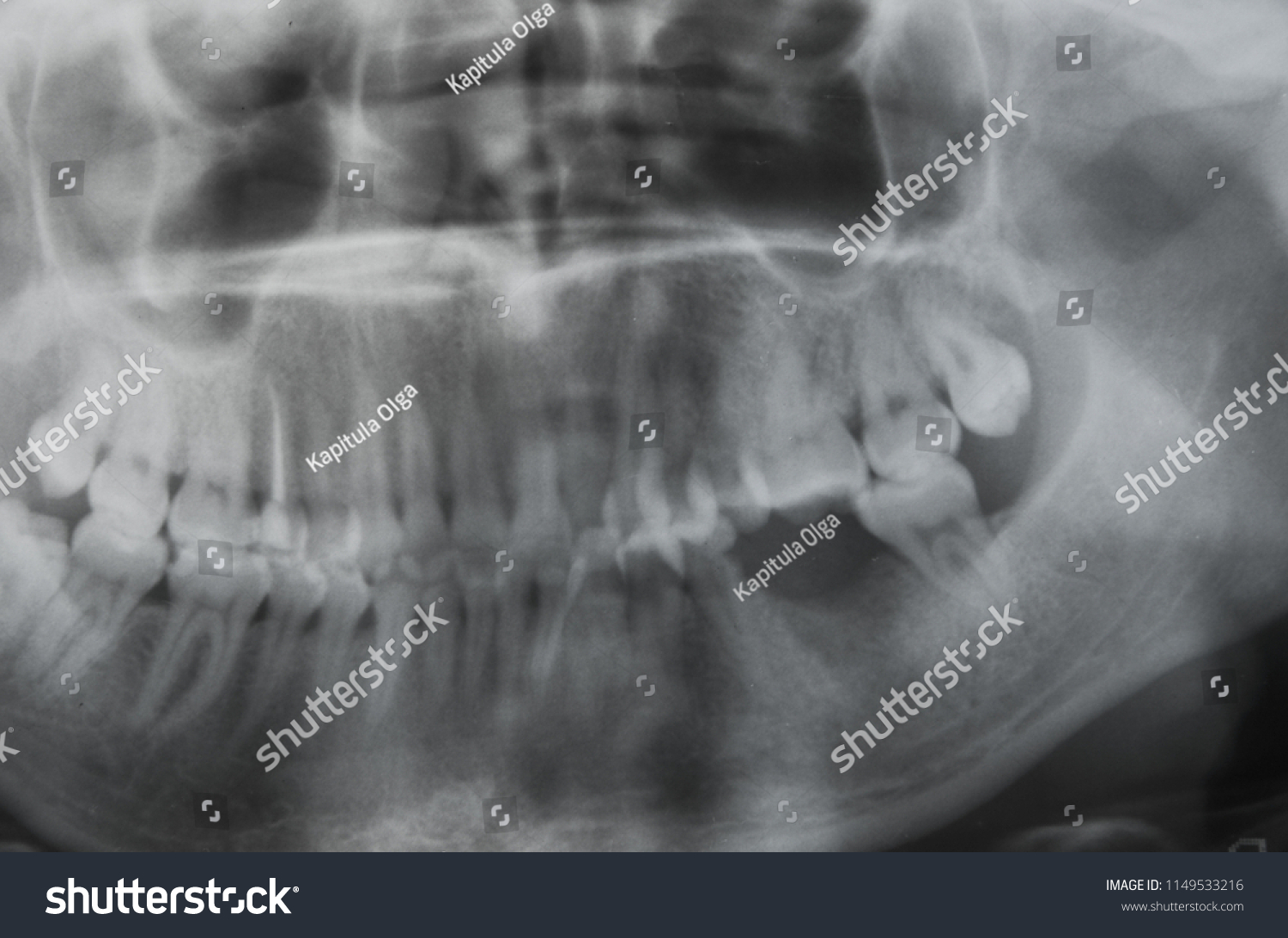 Photograph Teeth Xray Roentgen Teeth Patient Stock Photo 1149533216 ...