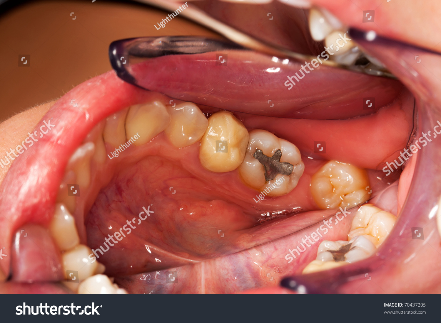 Photograph Posterior Lower Molar Teeth One Stock Photo 70437205 ...